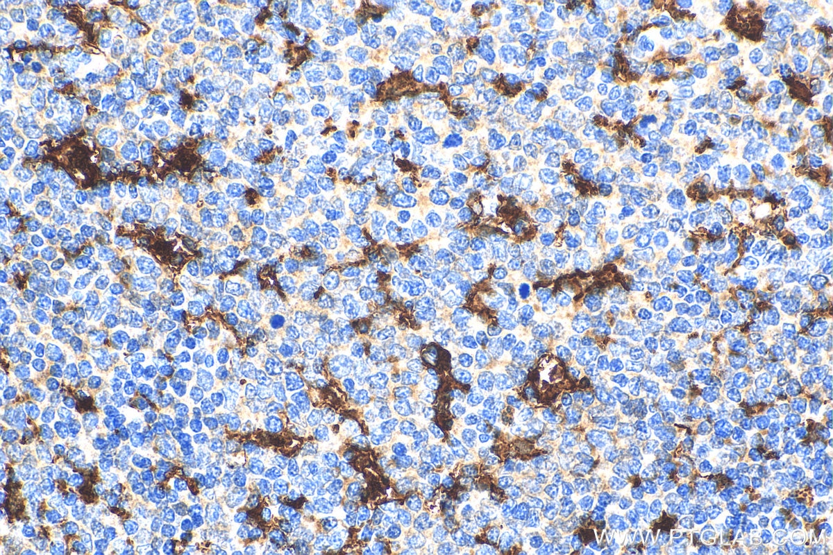Immunohistochemistry (IHC) staining of human tonsillitis tissue using IBA1 Polyclonal antibody (10904-1-AP)