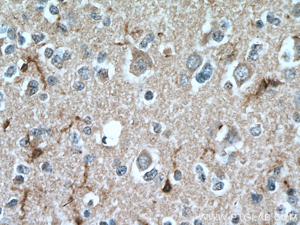 Immunohistochemistry (IHC) staining of human gliomas tissue using IBA1 Monoclonal antibody (66827-1-Ig)