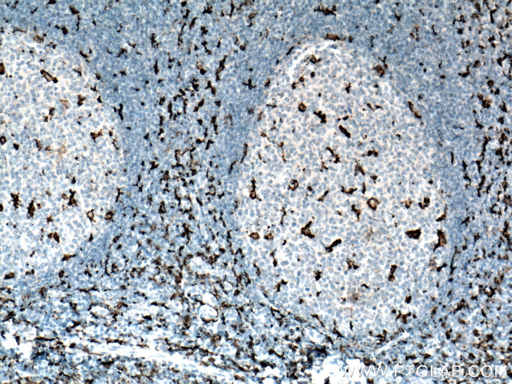 Immunohistochemistry (IHC) staining of human tonsillitis tissue using IBA1 Monoclonal antibody (66827-1-Ig)