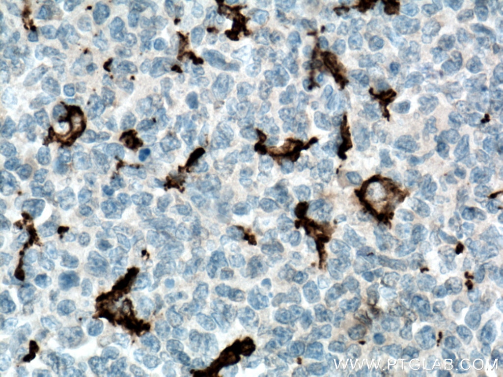 Immunohistochemistry (IHC) staining of human tonsillitis tissue using IBA1 Monoclonal antibody (66827-1-Ig)
