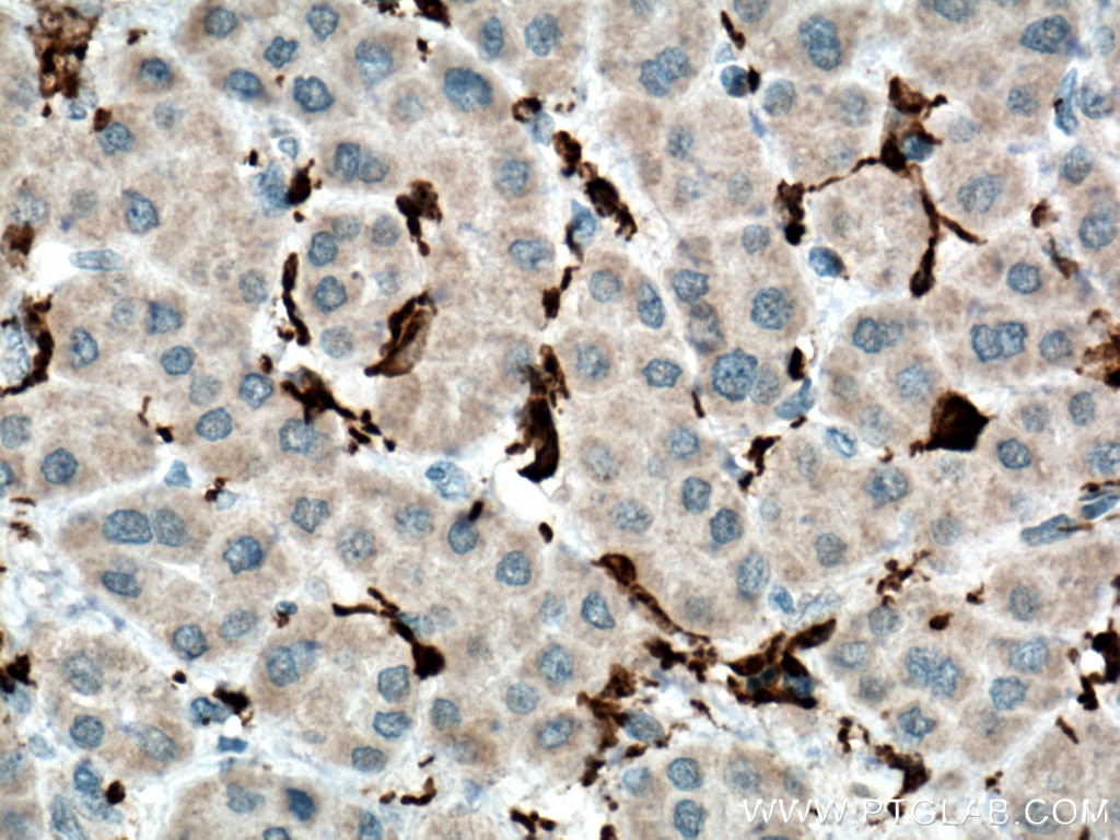 Immunohistochemistry (IHC) staining of human liver cancer tissue using IBA1 Monoclonal antibody (66827-1-Ig)