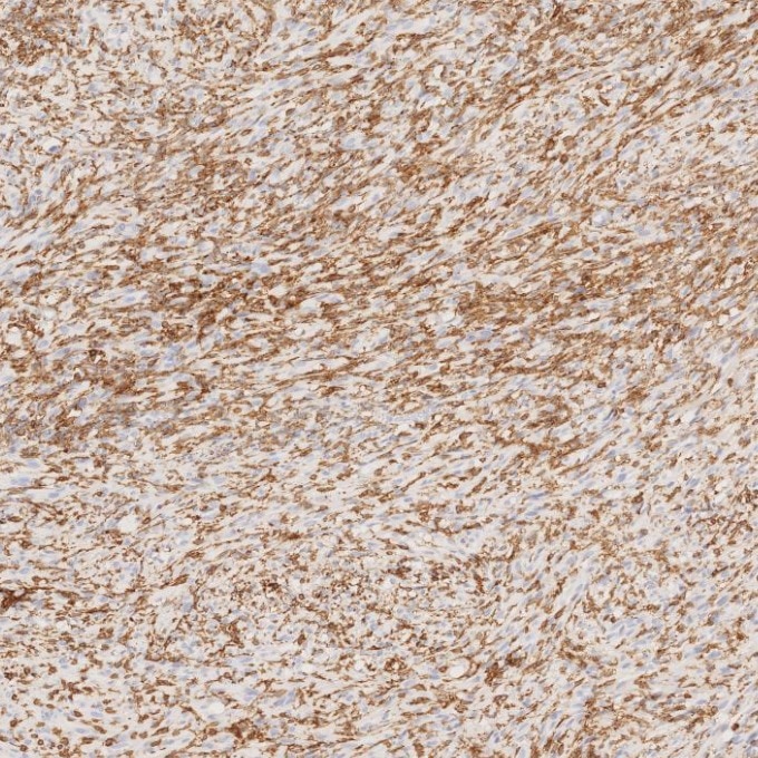 IHC staining of human gliomas using 66827-1-Ig Immunohistochemistry (IHC) staining of human gliomas tissue using human IBA1 Monoclonal antibody (66827-1-Ig)