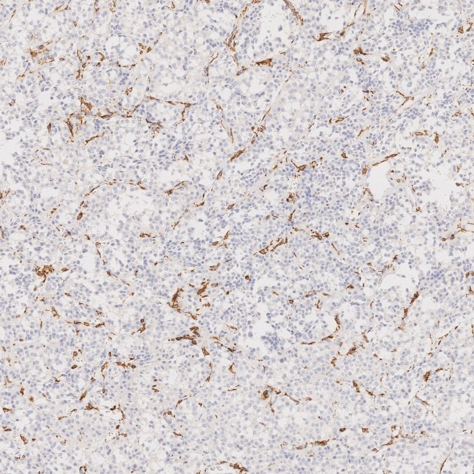 IHC staining of human pituitary adenoma using 66827-1-Ig Immunohistochemistry (IHC) staining of human pituitary adenoma tissue using human IBA1 Monoclonal antibody (66827-1-Ig)