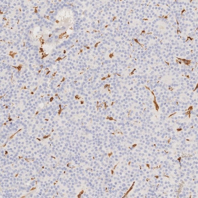 IHC staining of human pituitary adenoma using 66827-1-Ig Immunohistochemistry (IHC) staining of human pituitary adenoma tissue using human IBA1 Monoclonal antibody (66827-1-Ig)