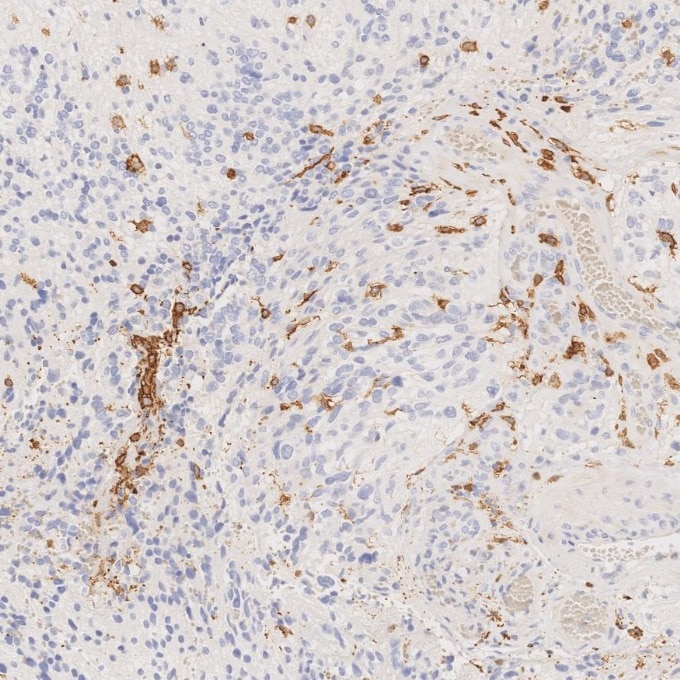 IHC staining of human gliomas using 66827-1-Ig Immunohistochemistry (IHC) staining of human gliomas tissue using human IBA1 Monoclonal antibody (66827-1-Ig)