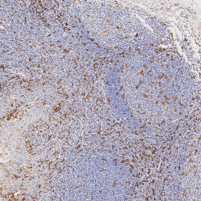 IHC staining of human tonsillitis using 66827-1-Ig Immunohistochemistry (IHC) staining of human tonsillitis tissue using human IBA1 Monoclonal antibody (66827-1-Ig)
