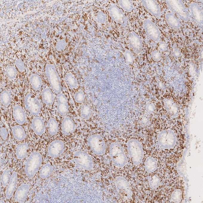 IHC staining of human appendicitis using 66827-1-Ig Immunohistochemistry (IHC) staining of human appendicitis tissue using human IBA1 Monoclonal antibody (66827-1-Ig)