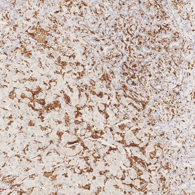 IHC staining of human liver using 66827-1-Ig Immunohistochemistry (IHC) staining of human liver tissue using human IBA1 Monoclonal antibody (66827-1-Ig)