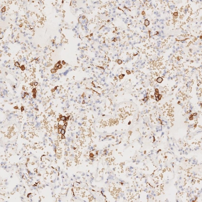 IHC staining of human lung using 66827-1-Ig Immunohistochemistry (IHC) staining of human lung tissue using human IBA1 Monoclonal antibody (66827-1-Ig)
