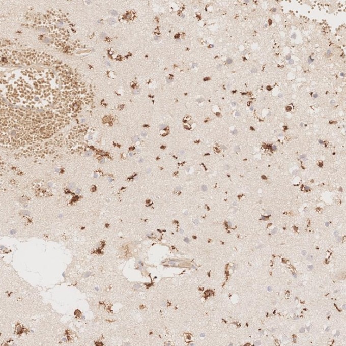 IHC staining of human brain using 66827-1-Ig Immunohistochemistry (IHC) staining of human brain tissue using human IBA1 Monoclonal antibody (66827-1-Ig)