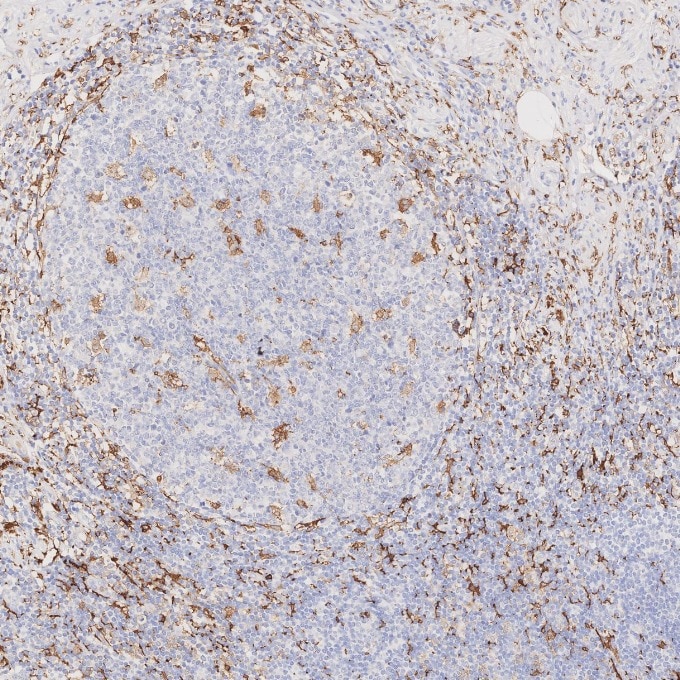 IHC staining of human appendicitis using 66827-1-Ig Immunohistochemistry (IHC) staining of human appendicitis tissue using human IBA1 Monoclonal antibody (66827-1-Ig)