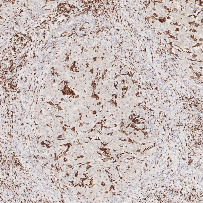 IHC staining of human liver using 66827-1-Ig Immunohistochemistry (IHC) staining of human liver tissue using human IBA1 Monoclonal antibody (66827-1-Ig)