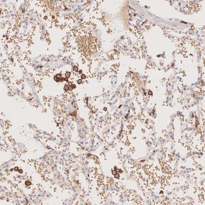 IHC staining of human lung using 66827-1-Ig Immunohistochemistry (IHC) staining of human lung tissue using human IBA1 Monoclonal antibody (66827-1-Ig)