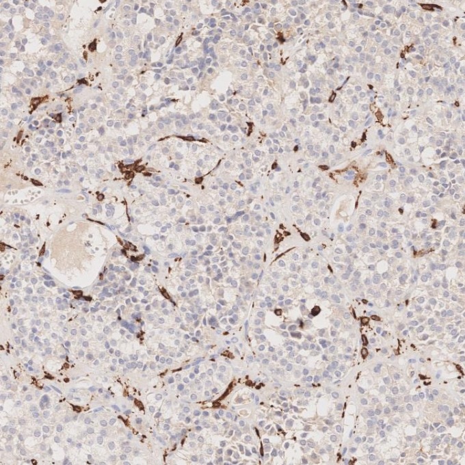 IHC staining of human pituitary adenoma using 66827-1-Ig Immunohistochemistry (IHC) staining of human pituitary adenoma tissue using human IBA1 Monoclonal antibody (66827-1-Ig)