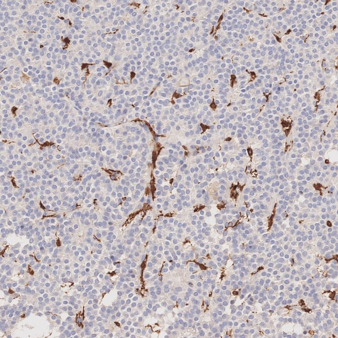 IHC staining of human pituitary adenoma using 66827-1-Ig Immunohistochemistry (IHC) staining of human pituitary adenoma tissue using human IBA1 Monoclonal antibody (66827-1-Ig)