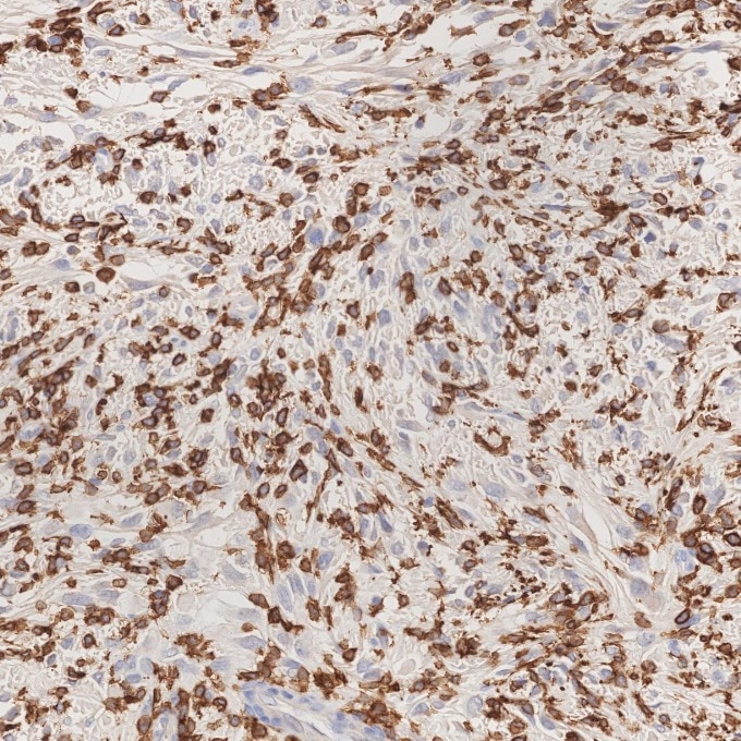 IHC staining of human gliomas using 66827-1-Ig Immunohistochemistry (IHC) staining of human gliomas tissue using human IBA1 Monoclonal antibody (66827-1-Ig)