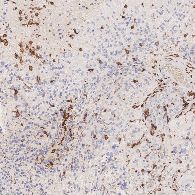 IHC staining of human gliomas using 66827-1-Ig Immunohistochemistry (IHC) staining of human gliomas tissue using human IBA1 Monoclonal antibody (66827-1-Ig)