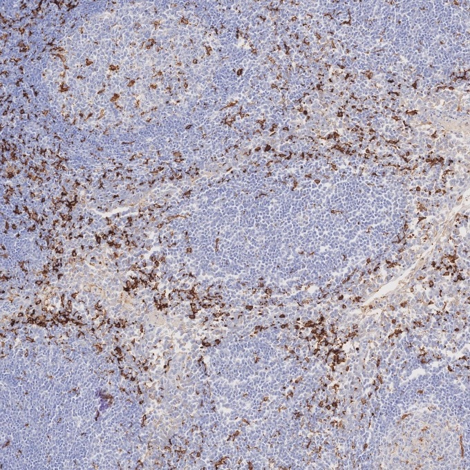 IHC staining of human tonsillitis using 66827-1-Ig Immunohistochemistry (IHC) staining of human tonsillitis tissue using human IBA1 Monoclonal antibody (66827-1-Ig)