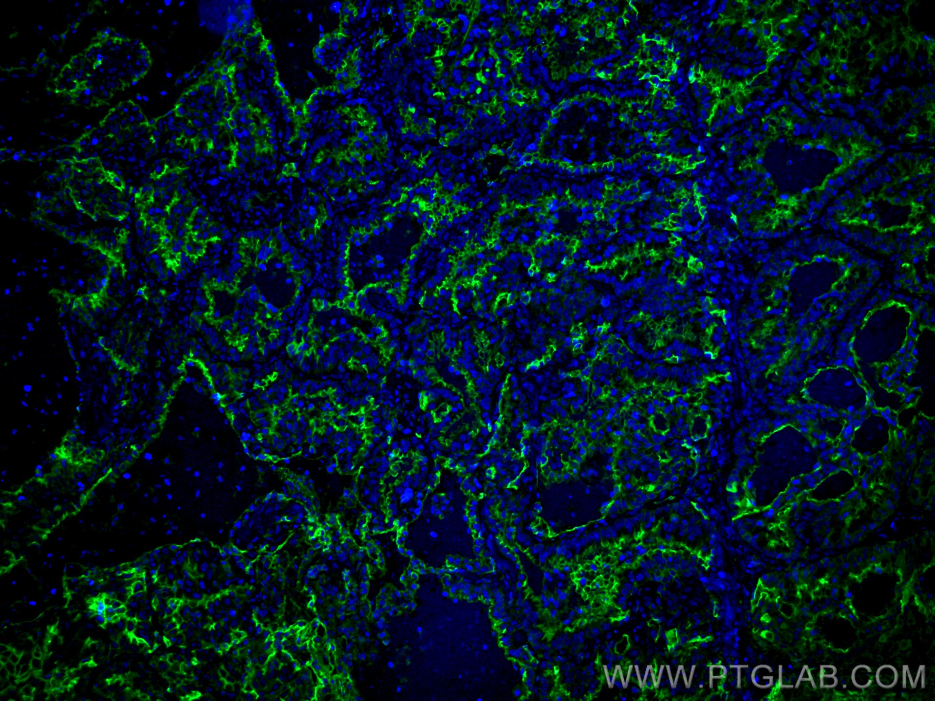 Immunofluorescence (IF) / fluorescent staining of human lung cancer tissue using ICAM-1 Polyclonal antibody (10831-1-AP)