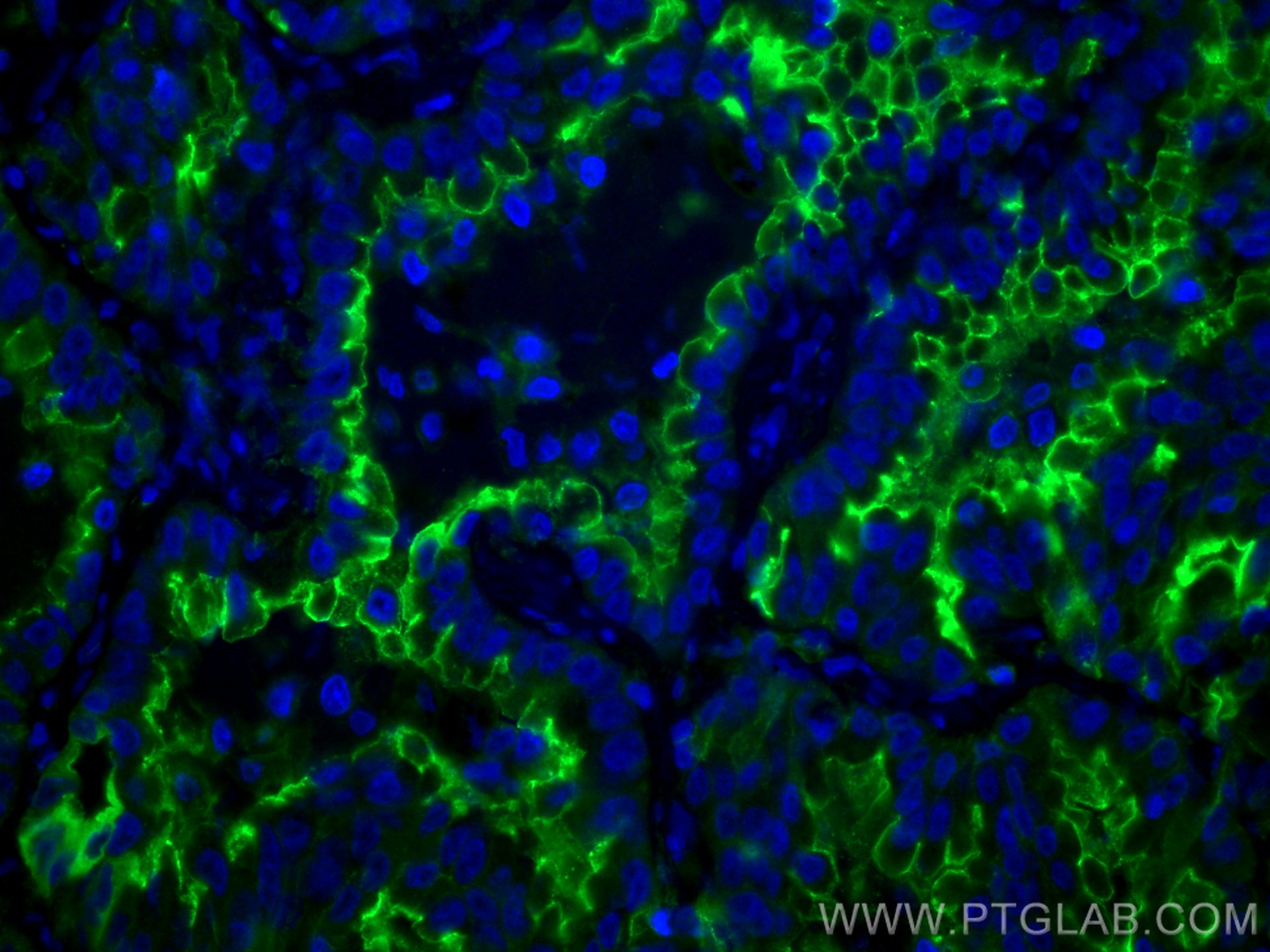 IF Staining of human lung cancer using 10831-1-AP