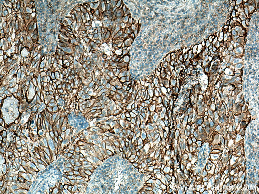 Immunohistochemistry (IHC) staining of human lung cancer tissue using ICAM-1 Polyclonal antibody (10831-1-AP)