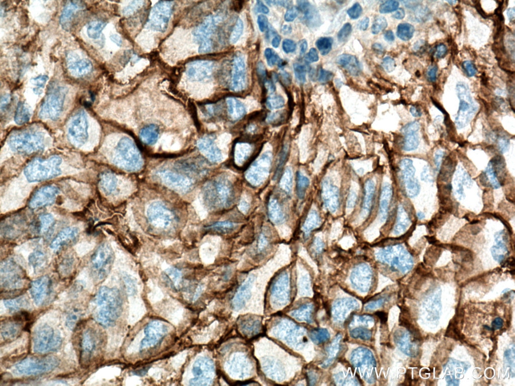 IHC staining of human lung cancer using 10831-1-AP
