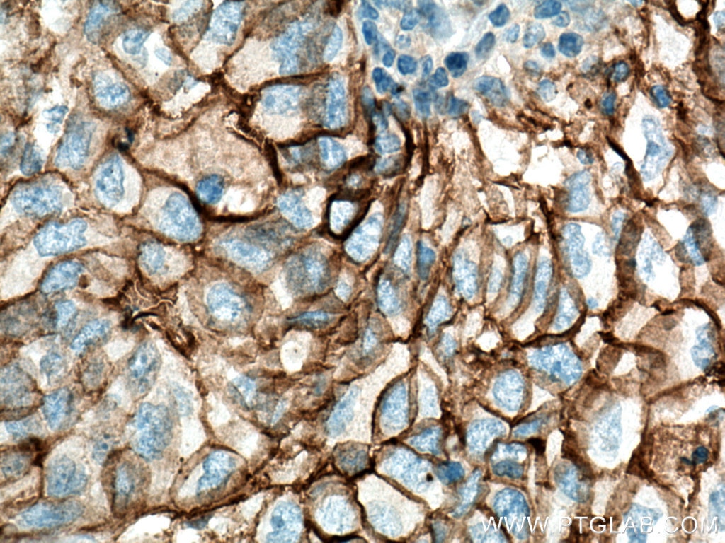 Immunohistochemistry (IHC) staining of human lung cancer tissue using ICAM-1 Polyclonal antibody (10831-1-AP)