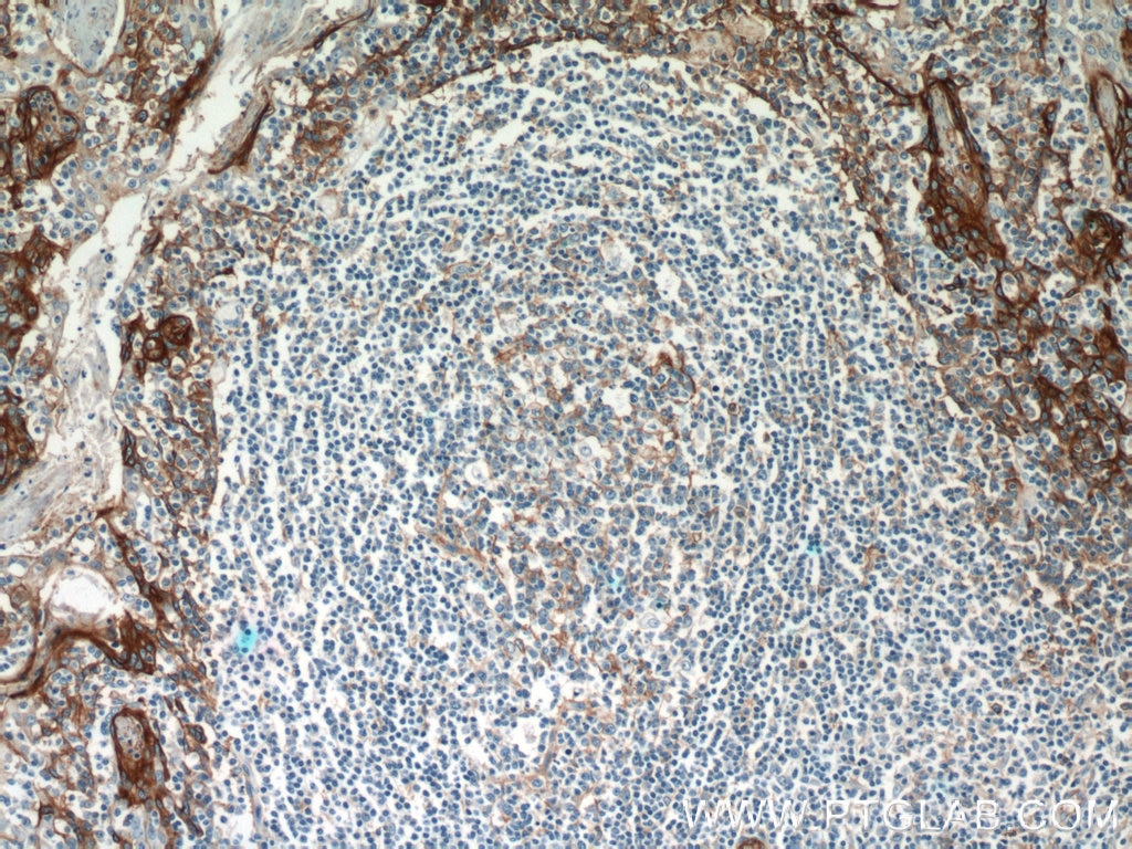 Immunohistochemistry (IHC) staining of human tonsillitis tissue using ICAM-1 Polyclonal antibody (10831-1-AP)
