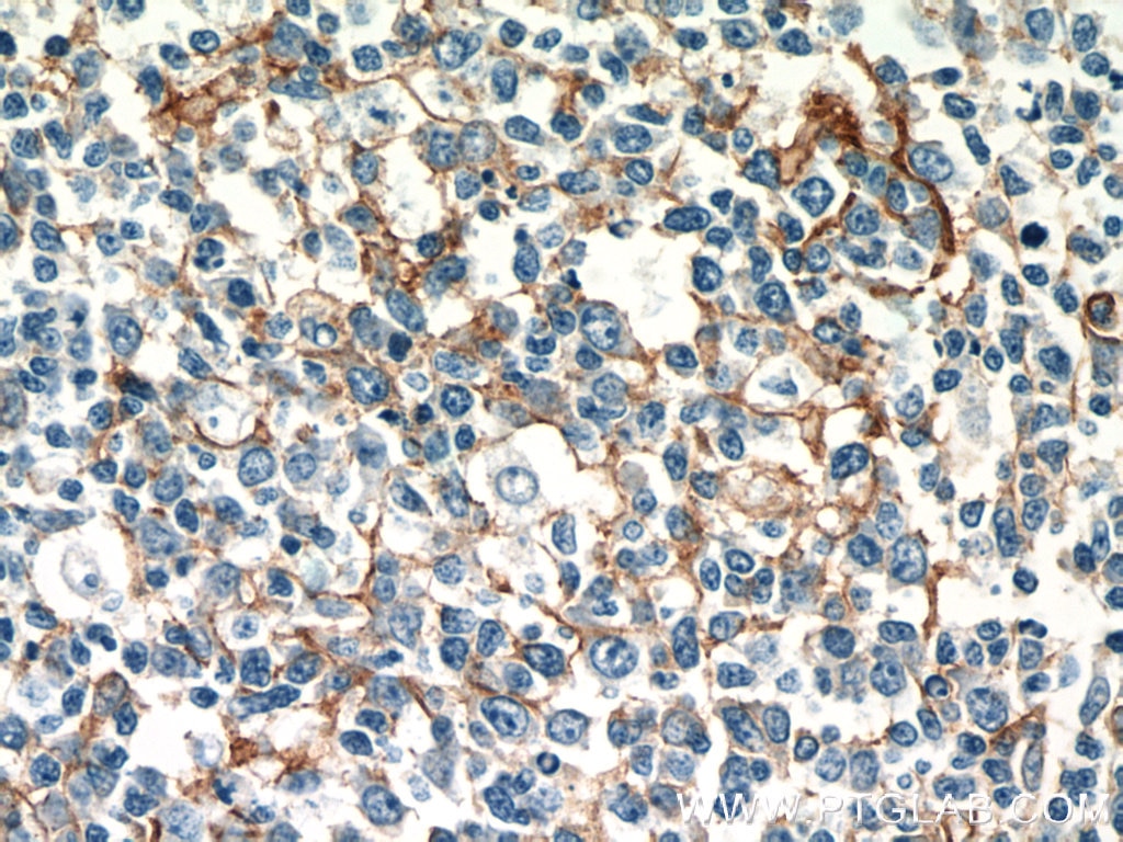 Immunohistochemistry (IHC) staining of human tonsillitis tissue using ICAM-1 Polyclonal antibody (10831-1-AP)