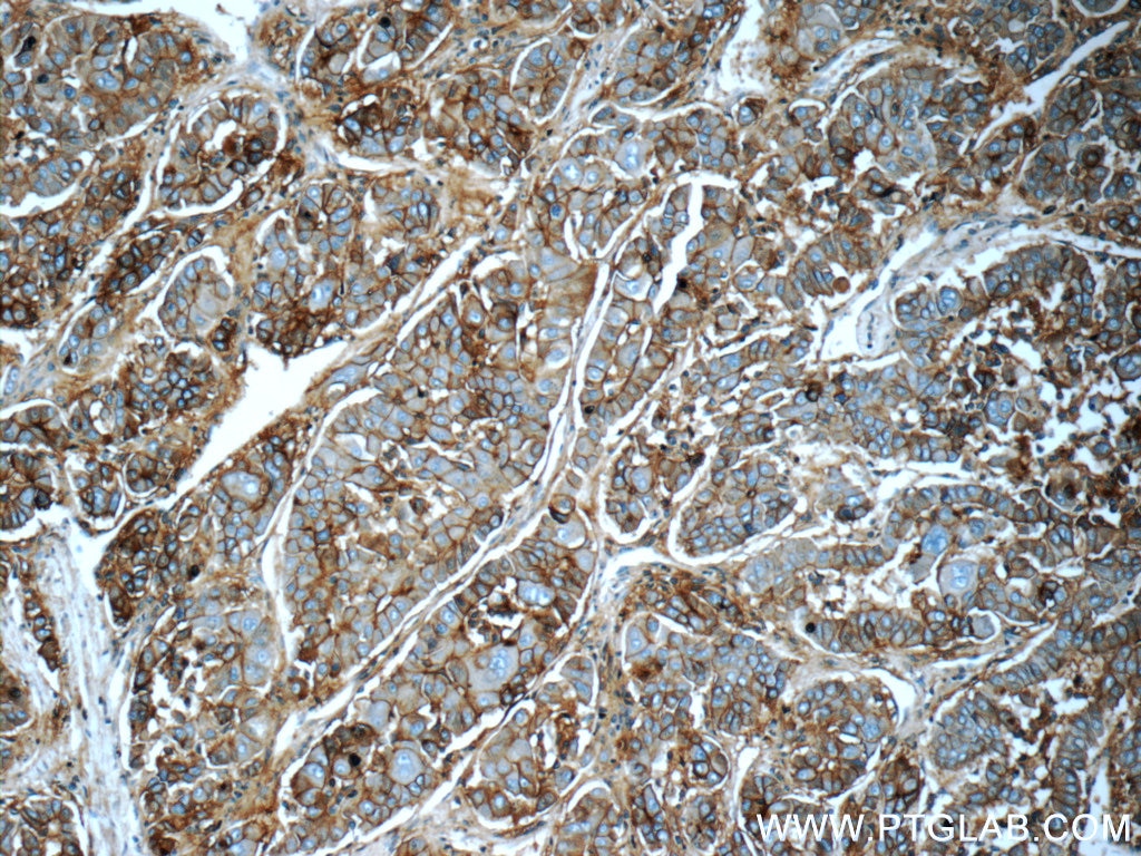Immunohistochemistry (IHC) staining of human liver cancer tissue using ICAM-1 Polyclonal antibody (10831-1-AP)