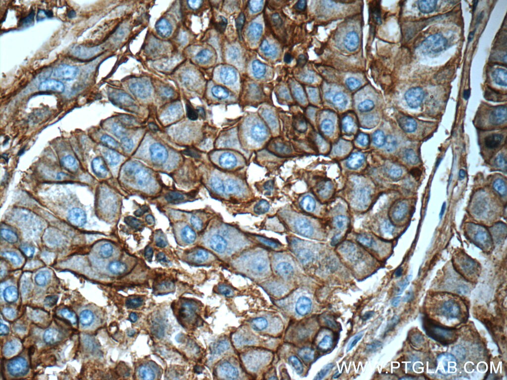 Immunohistochemistry (IHC) staining of human liver cancer tissue using ICAM-1 Polyclonal antibody (10831-1-AP)