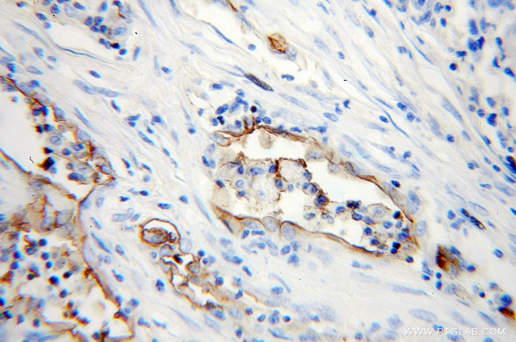 Immunohistochemistry (IHC) staining of human lung cancer tissue using ICAM-1 Polyclonal antibody (10831-1-AP)