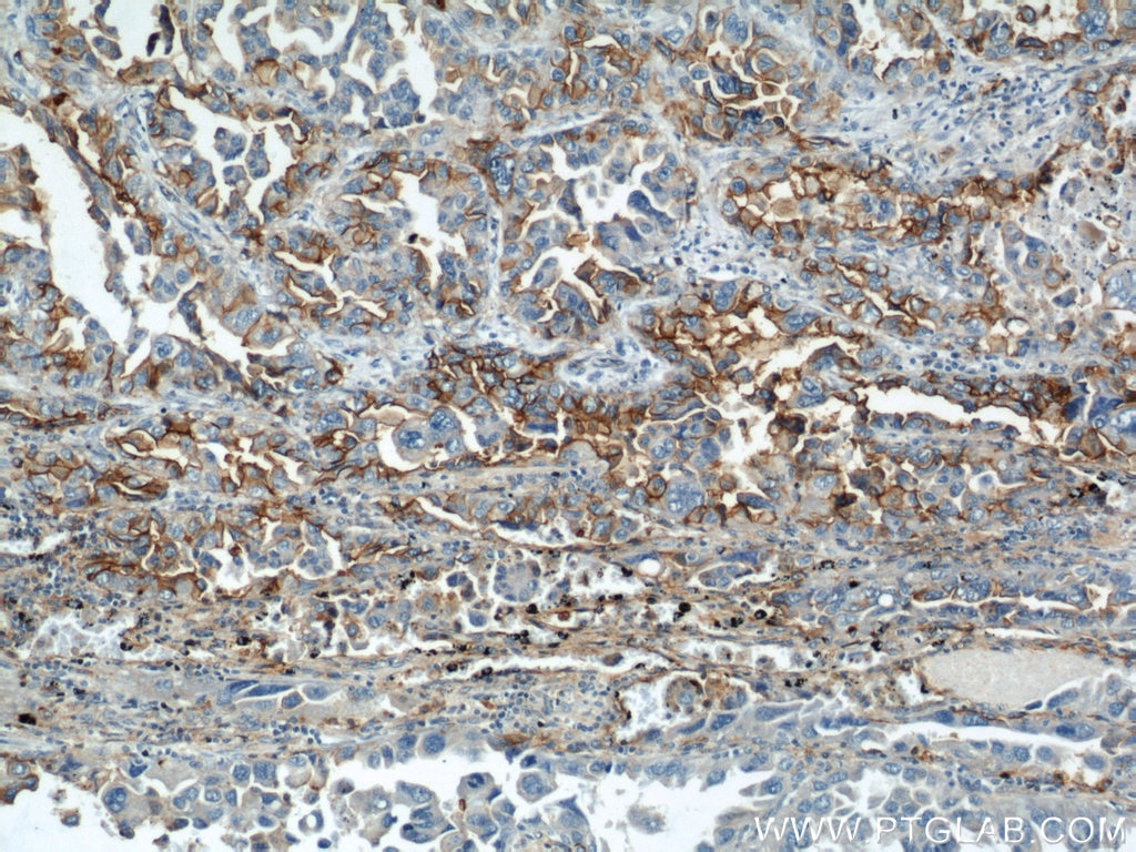 Immunohistochemistry (IHC) staining of human lung cancer tissue using ICAM-1 Polyclonal antibody (10831-1-AP)