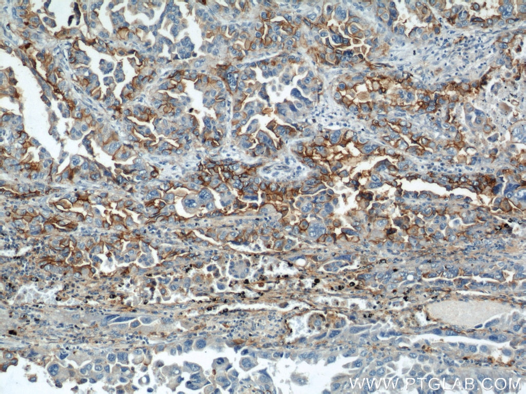 IHC staining of human lung cancer using 10831-1-AP