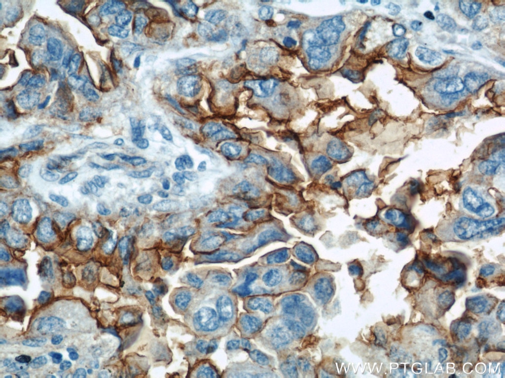 Immunohistochemistry (IHC) staining of human lung cancer tissue using ICAM-1 Polyclonal antibody (10831-1-AP)