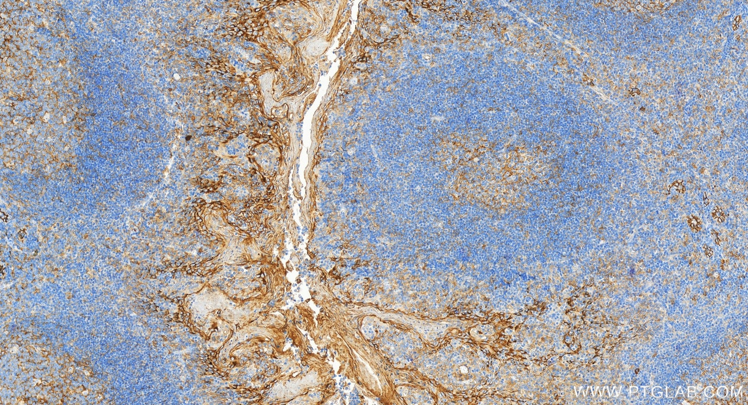 Immunohistochemistry (IHC) staining of human tonsillitis tissue using ICAM-1/CD54 Polyclonal antibody (10831-1-AP)