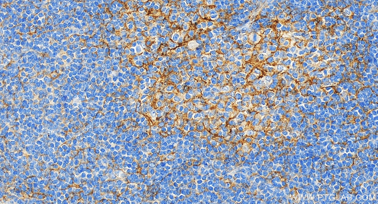 Immunohistochemistry (IHC) staining of human tonsillitis tissue using ICAM-1/CD54 Polyclonal antibody (10831-1-AP)