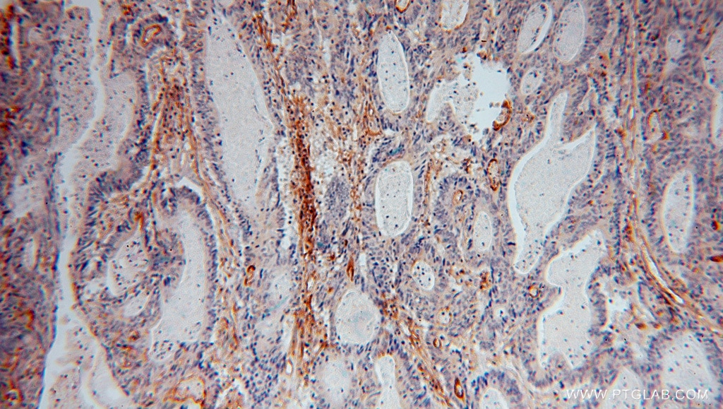 Immunohistochemistry (IHC) staining of human colon cancer tissue using ICAM-1 Polyclonal antibody (15364-1-AP)