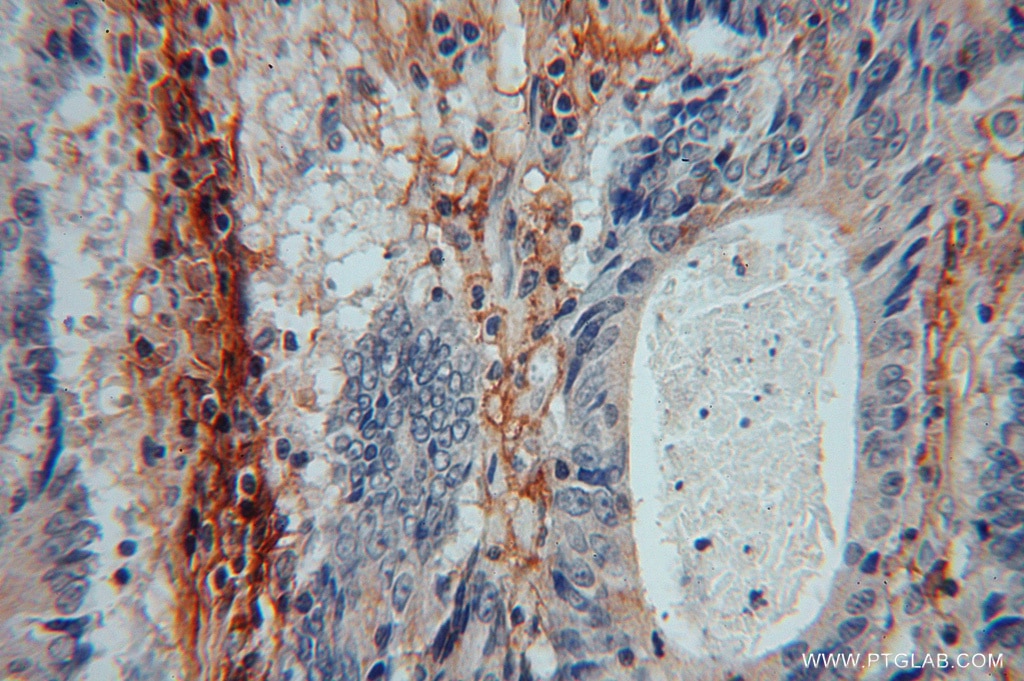 Immunohistochemistry (IHC) staining of human colon cancer tissue using ICAM-1 Polyclonal antibody (15364-1-AP)