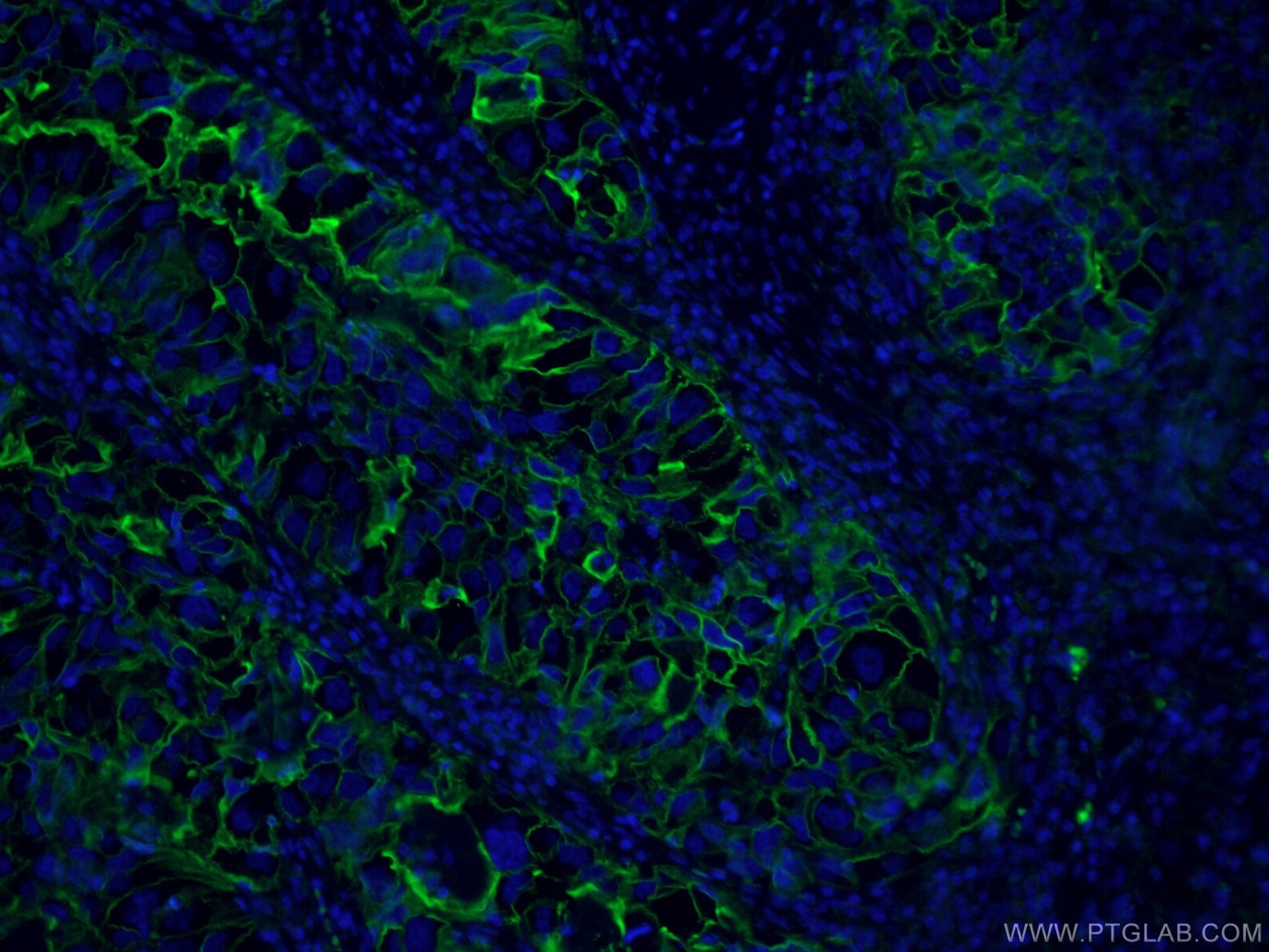 IF Staining of human lung cancer using 60299-1-Ig