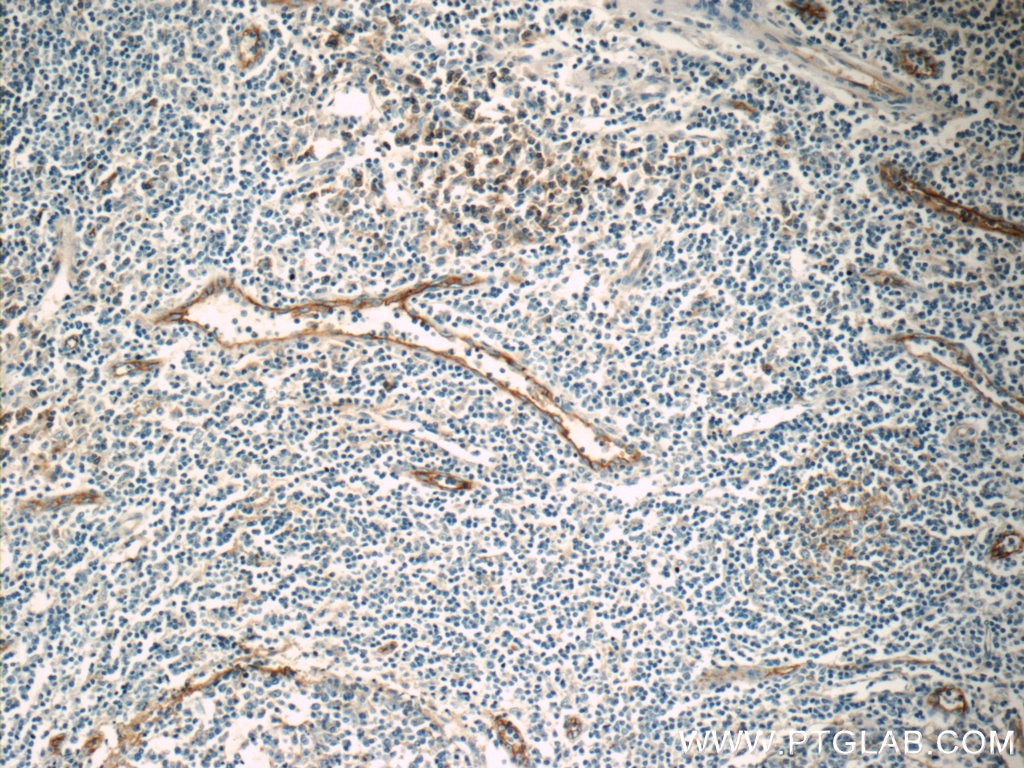 Immunohistochemistry (IHC) staining of human tonsillitis tissue using ICAM-1 Monoclonal antibody (60299-1-Ig)