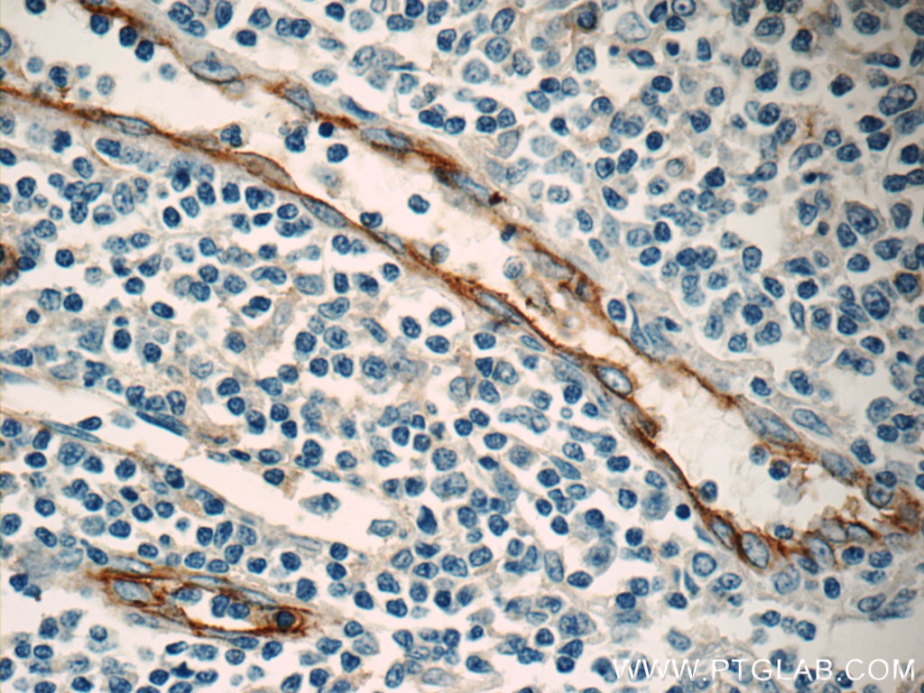 Immunohistochemistry (IHC) staining of human tonsillitis tissue using ICAM-1 Monoclonal antibody (60299-1-Ig)