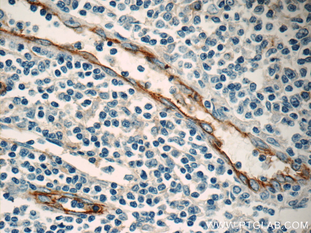 IHC staining of human tonsillitis using 60299-1-Ig