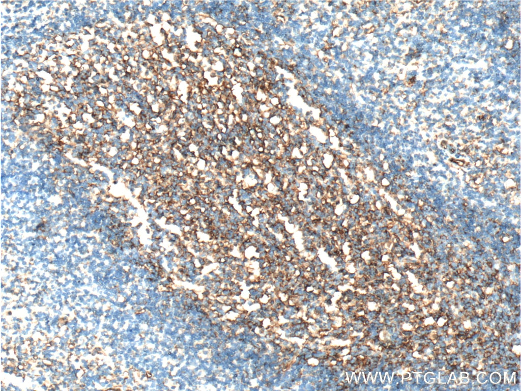 Immunohistochemistry (IHC) staining of human tonsillitis tissue using ICAM-1 Monoclonal antibody (60299-1-Ig)