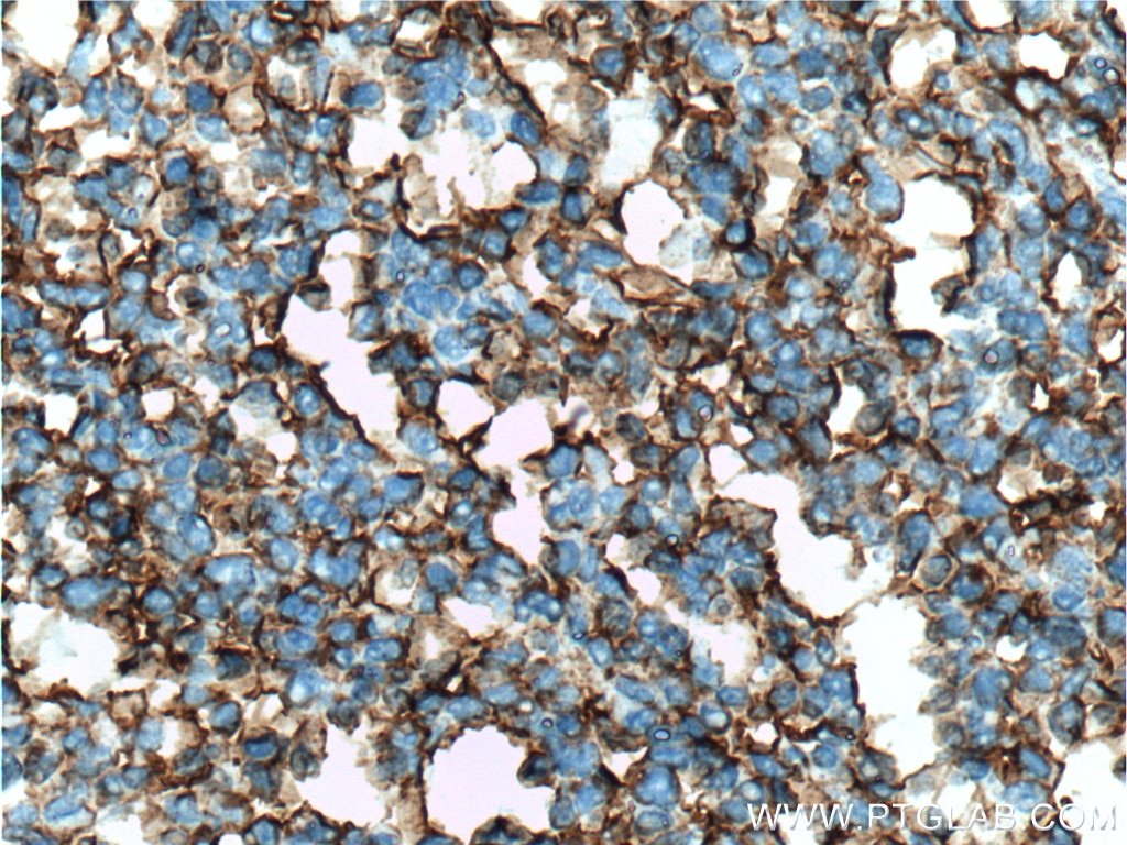 Immunohistochemistry (IHC) staining of human tonsillitis tissue using ICAM-1 Monoclonal antibody (60299-1-Ig)