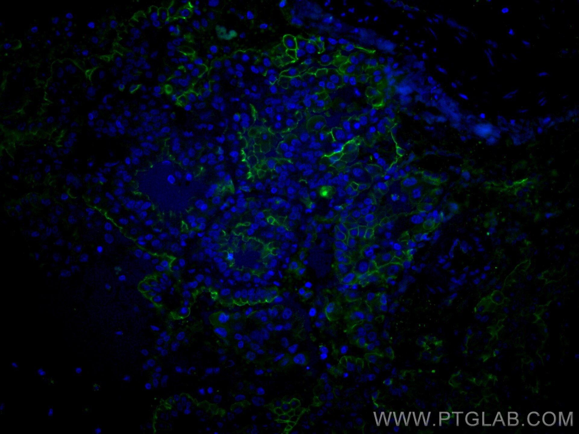 IF Staining of human lung cancer using CL488-10831