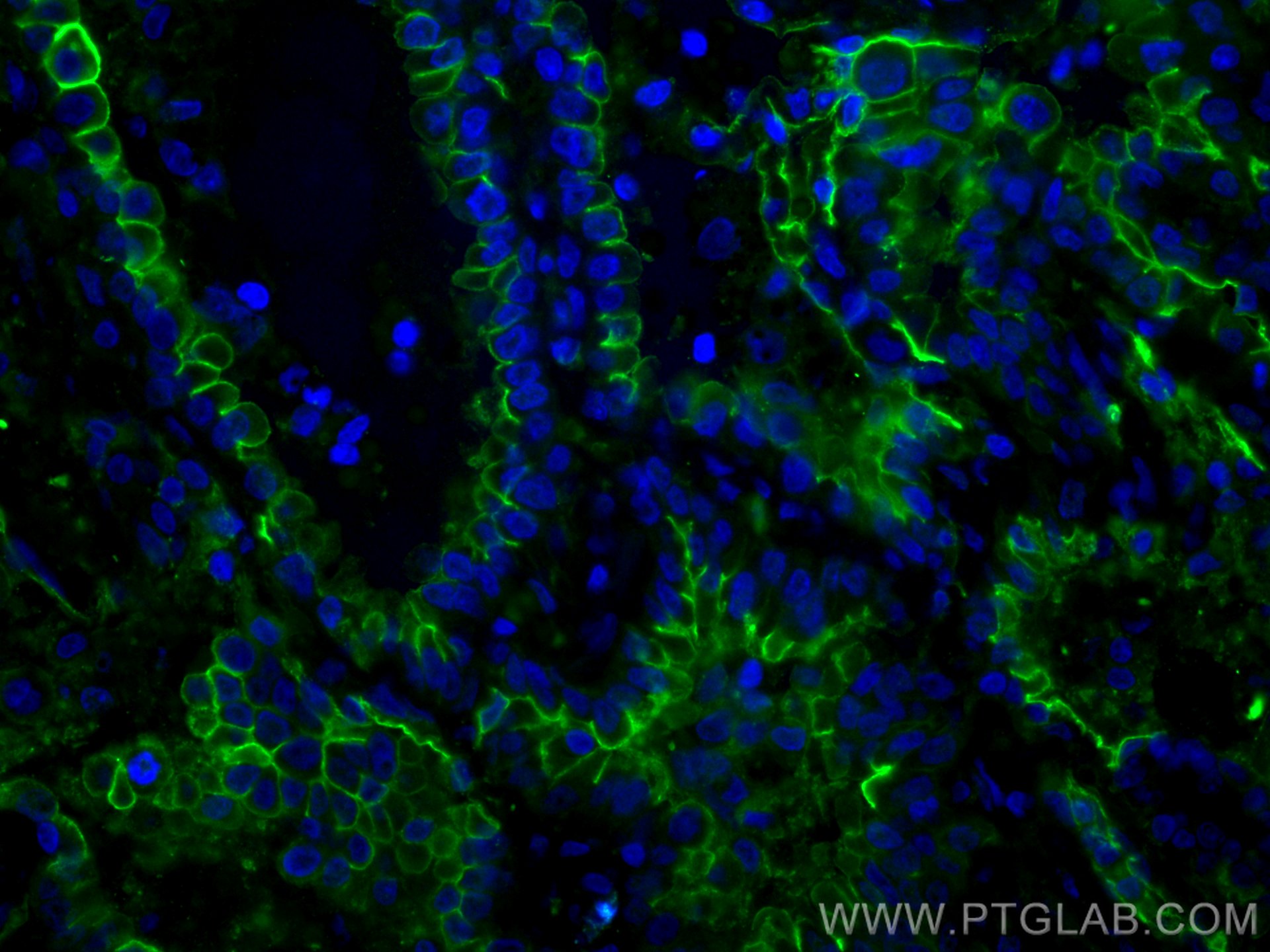 Immunofluorescence (IF) / fluorescent staining of human lung cancer tissue using CoraLite® Plus 488-conjugated ICAM-1 Polyclonal an (CL488-10831)