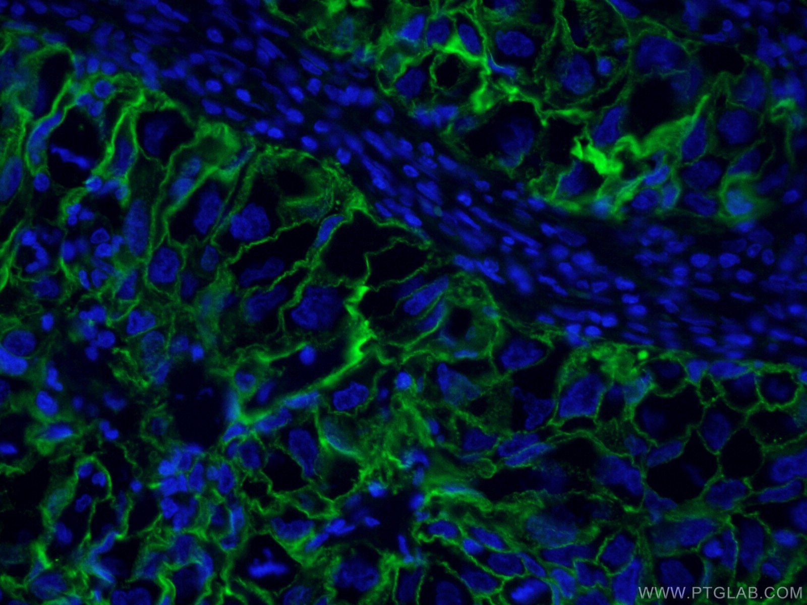 Immunofluorescence (IF) / fluorescent staining of human lung cancer tissue using CoraLite® Plus 488-conjugated ICAM-1 Monoclonal an (CL488-60299)