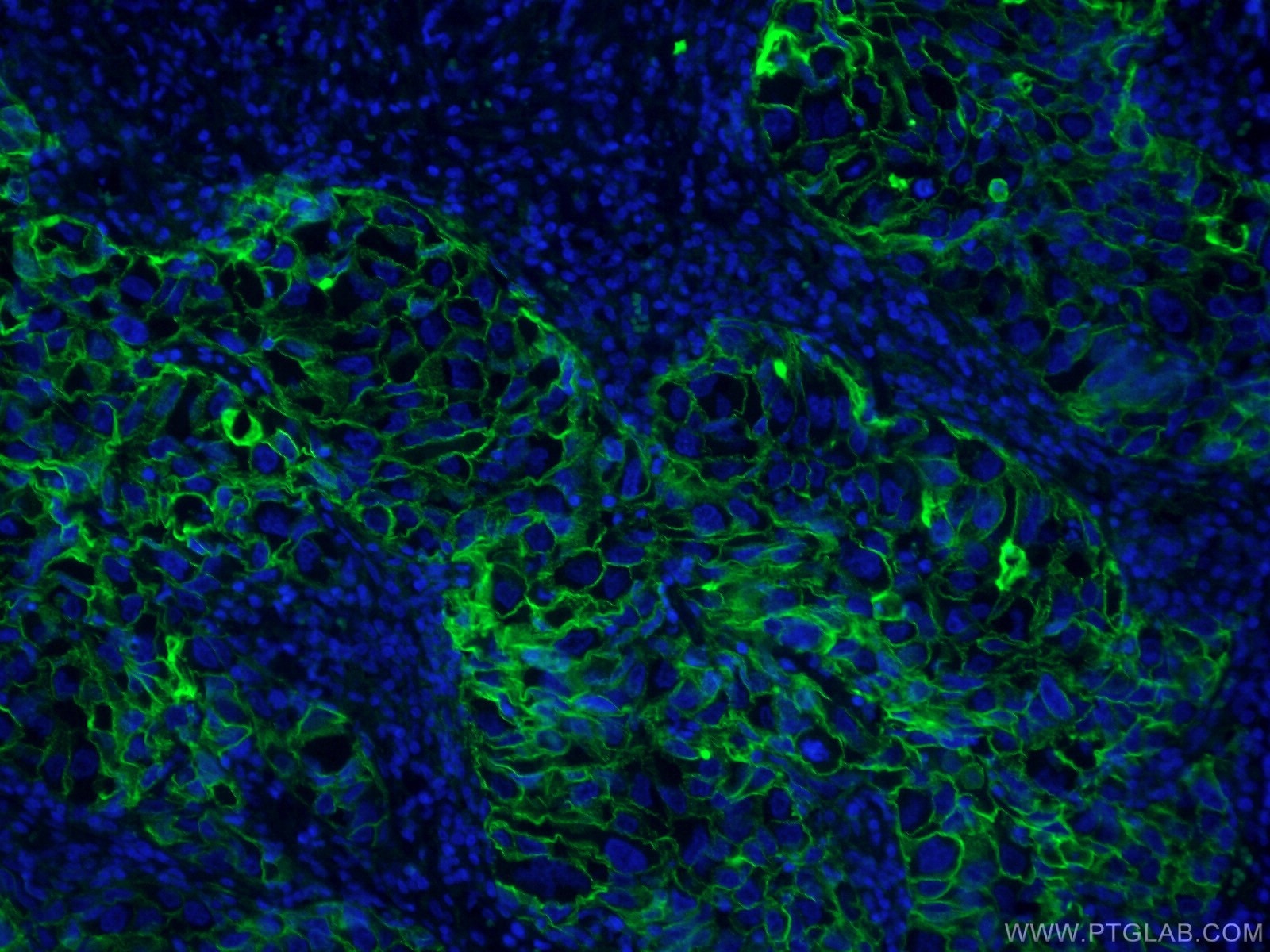 Immunofluorescence (IF) / fluorescent staining of human lung cancer tissue using CoraLite® Plus 488-conjugated ICAM-1 Monoclonal an (CL488-60299)