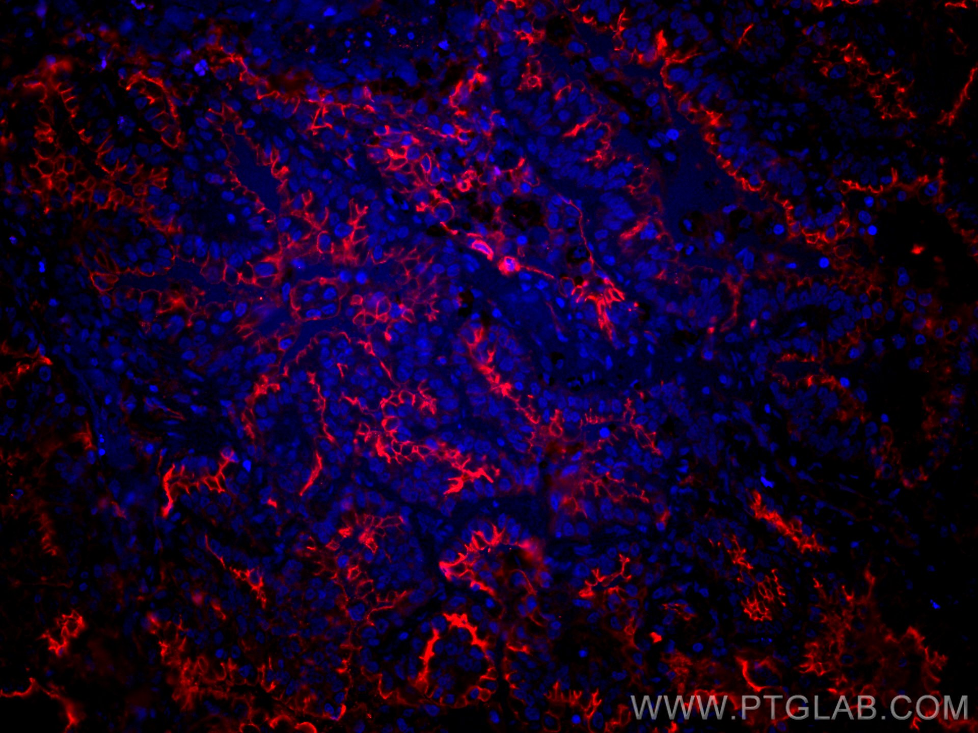 Immunofluorescence (IF) / fluorescent staining of human lung cancer tissue using CoraLite®594-conjugated ICAM-1 Polyclonal antibody (CL594-10831)